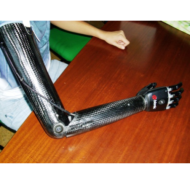  Hybrid Prosthesis for Elbow disarticulation