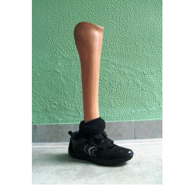  Prosthesis for "Chopart" amputation with anterior support
