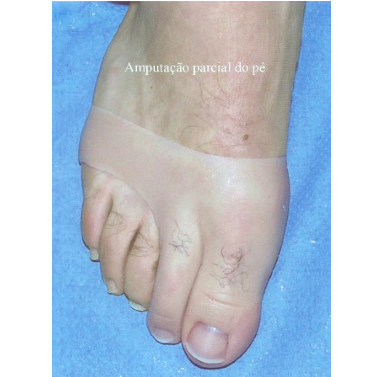 Prosthesis for the Amputation of the first and second toes in Silicone