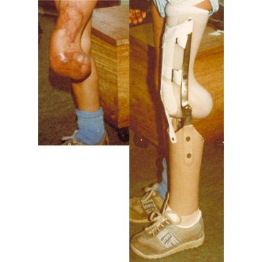 Transtibial Prosthesis with Knee Joint Blockage