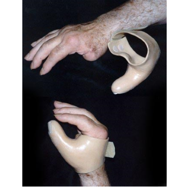  Aesthetic and Functional Prosthesis for Thumb